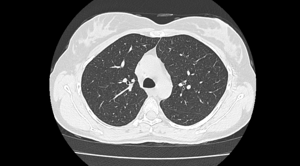 Hrct Scan 