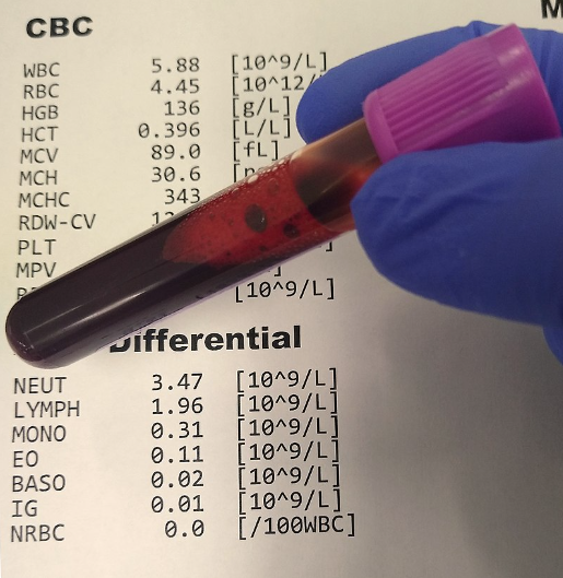 Best Haemogram CBC Pathology Lab Near Nanded City In Pune Best Haemogram CBC Pathology Lab Near Nanded City In Pune