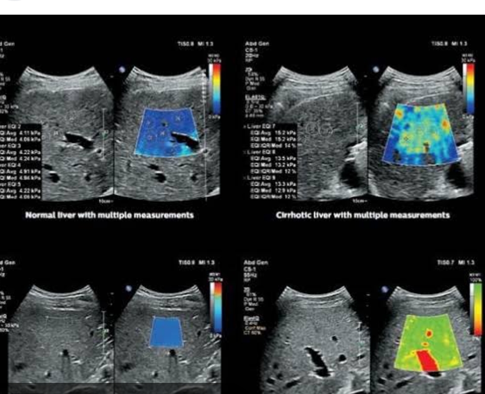 Best Liver Elastography Center Near Nanded City in Pune